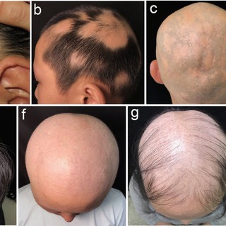 Alopecia Areata