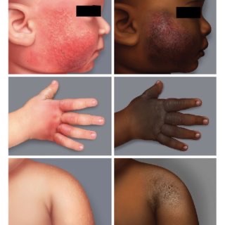 Atopic Dermatitis