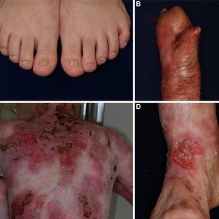 Epidermolysis Bullosa