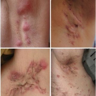 Hidradenitis Suppurativa