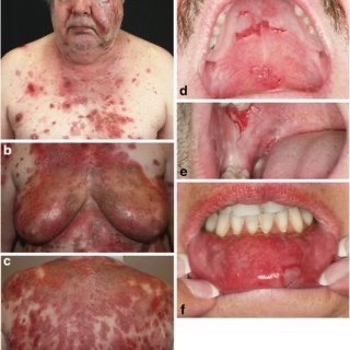 Pemphigus