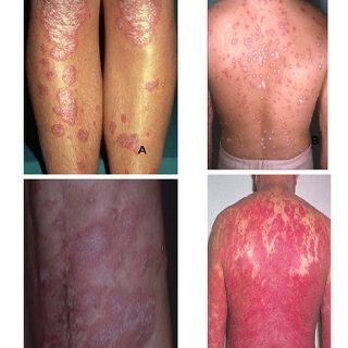 Psoriasis