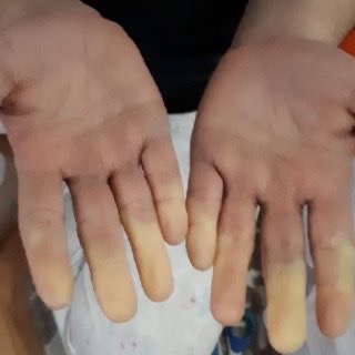 Raynaud’s Phenomenon