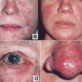 Rosacea<br />
